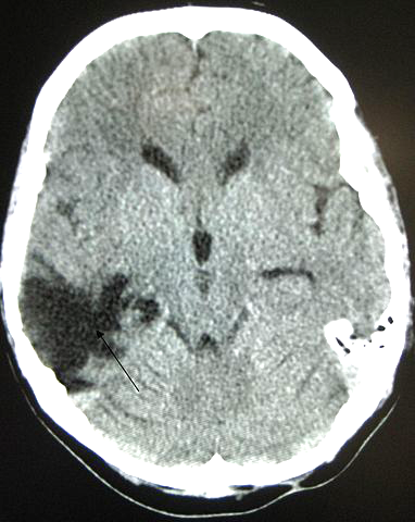 Traumatic-brain-injury